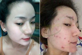 Cách trị mụn bằng thuốc bắc hiệu quả của khách hàng MSKH: TN0766