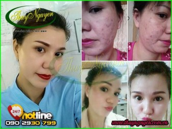 Cách Nào Chữa khỏi Mụn Cám ?