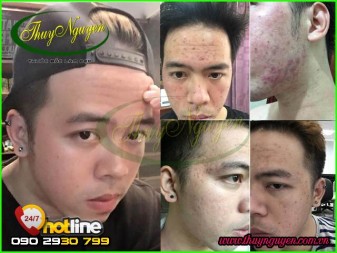 Cách Trị Mụn Cám Cho Nam Giới Nhanh Nhất