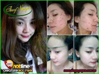 Nguyên Nhân Gây Mụn Cám Và Cách Trị Mụn Nhanh Nhất